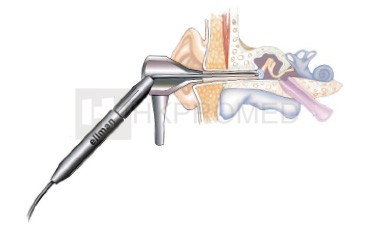 射頻鼓膜切開術(shù)輔助裝置